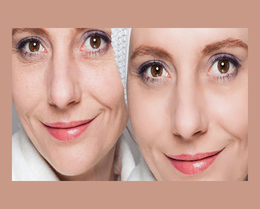 Facial Rejuvenation